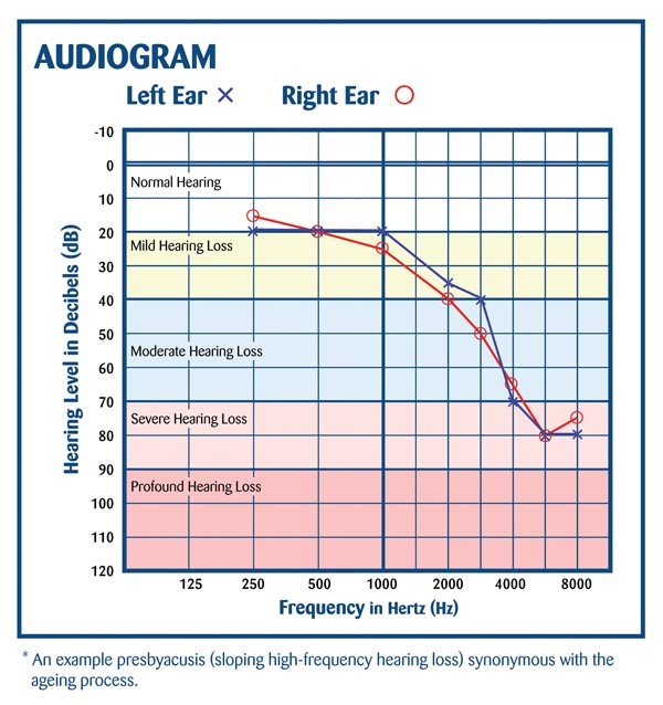 Audiology Chart